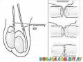 Reversion De Vasectomia Dibujo Para Entender La Reversion De La Basectomia Para Eyacular Nuevamente Y Volver A Ser Fertil