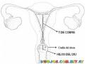 Metodo Anticonceptivo TdeCobre Conocido Como DIU Dibujo De La T De Cobre Para Pintar Y Metodo Para Evitar Embarazos