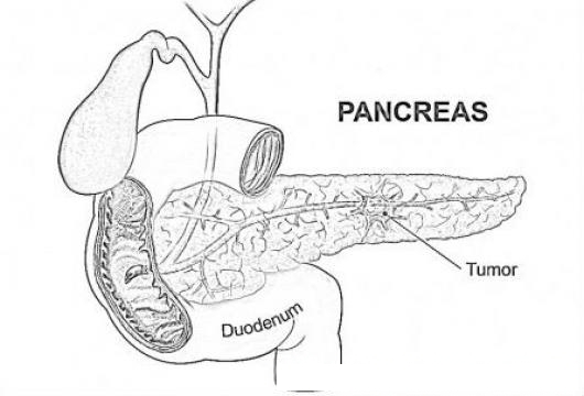 Pancreatic Cancer Printable Coloring Page Cancer De Pancreas Para