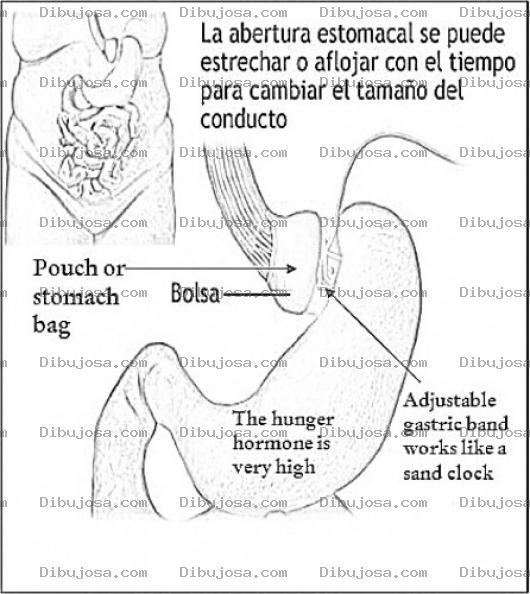 Dibujo para colorear Banda Gastrica Ajustable Dibujo Para Colorear La Operacion De Lapband O Banda Gastrica Para Combatir La Obesidad Enlos Gorditos