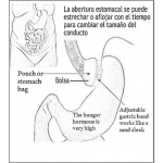 Dibujo para colorear Banda Gastrica Ajustable Dibujo Para Colorear La Operacion De Lapband O Banda Gastrica Para Combatir La Obesidad Enlos Gorditos