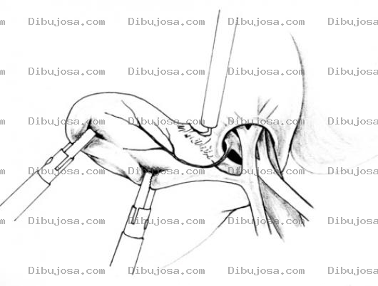 Dibujo para colorear Operacion De Vesicula Para Pintar Y Colorear Dibujo De Extraccion De Besicula Por Piedras Biliares