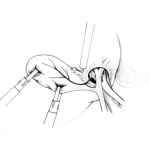 Dibujo para colorear Operacion De Vesicula Para Pintar Y Colorear Dibujo De Extraccion De Besicula Por Piedras Biliares