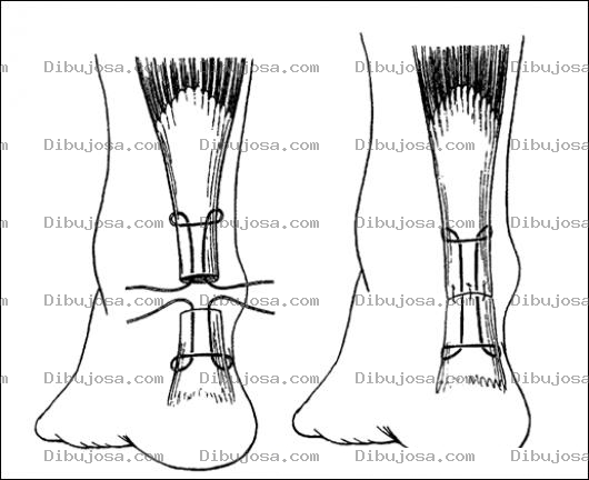 Dibujo para colorear Cirugia Del Tendon De Aquiles Para Pintar Y Colorear