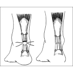 Dibujo para colorear Cirugia Del Tendon De Aquiles Para Pintar Y Colorear