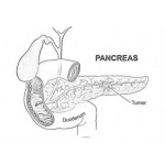 Dibujo para colorear Pancreatic Cancer Printable Coloring Page Cancer De Pancreas Para Colorear E Imprimir