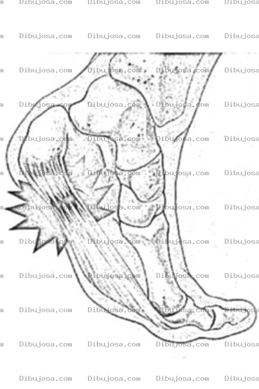 Dibujo para colorear Plantar Fasciitis Coloring Page