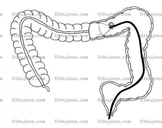 Dibujo para colorear Dibujo De Colonoscopia Para Pintar Y Colorear