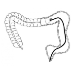 Dibujo para colorear Dibujo De Colonoscopia Para Pintar Y Colorear