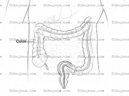 Dibujo para colorear Colonoscopia Dibujo Del Examen De Colon por colon irritable para detectar y tratar cancer de colon o enfermedades del colon Para Pintar Y Colorear antes del remicade