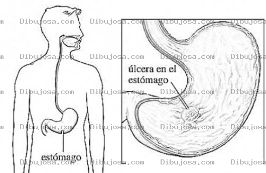 Dibujo para colorear Gastritis Ulceras Pepticas Dibujo De Ulcera Gastrica En El Estomago Para Pintar Y Colorear