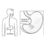 Dibujo para colorear Gastritis Ulceras Pepticas Dibujo De Ulcera Gastrica En El Estomago Para Pintar Y Colorear