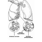 Dibujo para colorear Efisema Pulmonar Enfermedades Por Fumar Cigarrillos De Tabaco Dibujp De Bronquios Para Entender Enfermedades En Los Alveolos Para Pintar Y Colorear