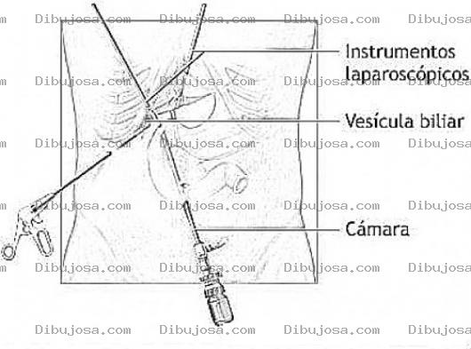 Dibujo para colorear Operacion De Vesicula Biliar Por Laparoscopia Dibujo Para Pintar Y Colorear Operasion Laser De La Besicula Viliar Con Camara Laparoscopica