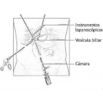 Dibujo para colorear Operacion De Vesicula Biliar Por Laparoscopia Dibujo Para Pintar Y Colorear Operasion Laser De La Besicula Viliar Con Camara Laparoscopica