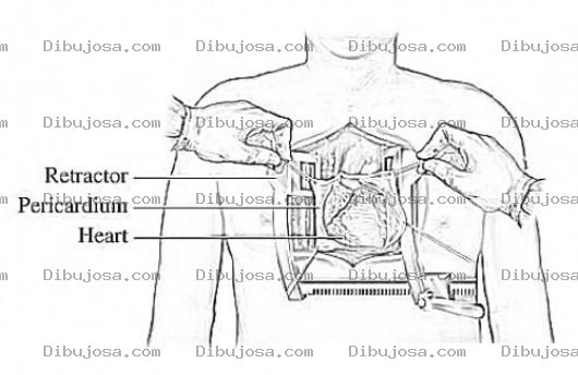 Dibujo para colorear Operacion De Corazon Abierto Por Infarto Dibujo Para Pintar Y Colorear Una Operacion De Corazon Por Cardiologos Especializados