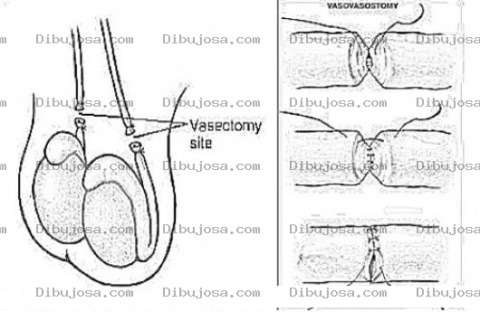 Dibujo para colorear Reversion De Vasectomia Dibujo Para Entender La Reversion De La Basectomia Para Eyacular Nuevamente Y Volver A Ser Fertil