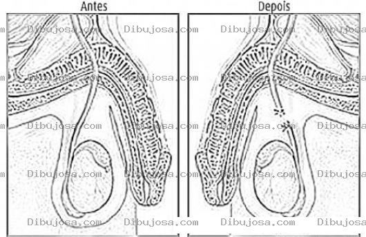 Dibujo para colorear Vasectomia Opercion De Infertilidad Dibujo De La Basectomia Antes Y Despues Para Pintar Y Colorear