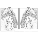 Dibujo para colorear Vasectomia Opercion De Infertilidad Dibujo De La Basectomia Antes Y Despues Para Pintar Y Colorear