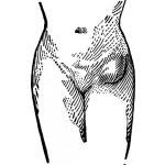 Dibujo para colorear Dibujo De Hernia Inguinal Para Pintar Y Colorear
