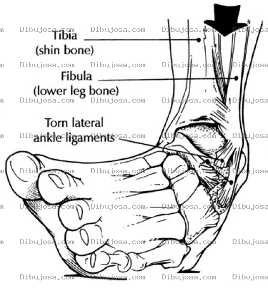 Dibujo para colorear Tobillo Quebrado Dibujo De Una Quebradura De Tobillo Para Pintar Y Colorear Tobillo Quebrado O Rotura De Ligamentos De Tobillo