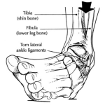Dibujo para colorear Tobillo Quebrado Dibujo De Una Quebradura De Tobillo Para Pintar Y Colorear Tobillo Quebrado O Rotura De Ligamentos De Tobillo
