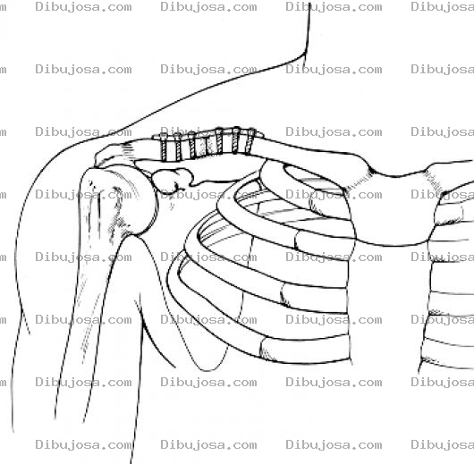 Dibujo para colorear Operacion De Clavicula Para Pintar Y Colorear Placa De Platino Con Tornillos En El Hueso De Una Clavicula Quebrada Y Fracturada