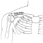 Dibujo para colorear Operacion De Clavicula Para Pintar Y Colorear Placa De Platino Con Tornillos En El Hueso De Una Clavicula Quebrada Y Fracturada