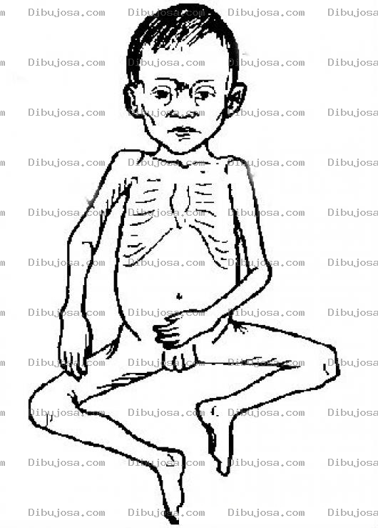 Dibujo para colorear Desnutricion Infanitl Dibujo Del Cuerpo De Un Nino Desnutrido Para Pintar Y Colorear Hambruna Infantil