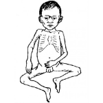 Dibujo para colorear Desnutricion Infanitl Dibujo Del Cuerpo De Un Nino Desnutrido Para Pintar Y Colorear Hambruna Infantil
