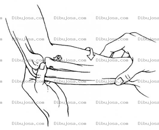 Dibujo para colorear Fractura De Antebrazo Para Colorear