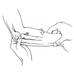 Dibujo para colorear Fractura De Antebrazo Para Colorear